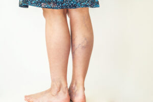 A person’s legs with visible veins that could be treated with laser vein removal