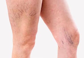 Types of veins that we treat Johnson City TN