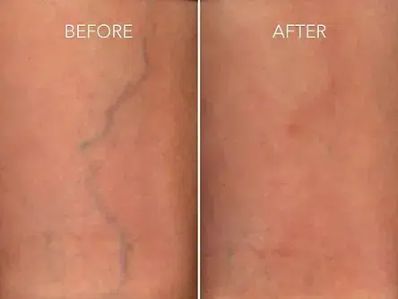 sclerotherapy before and after