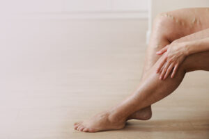 A close-up shot of legs with varicose veins