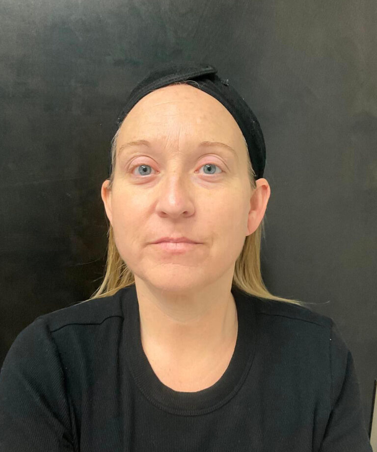 After Image: Lumecca IPL - front