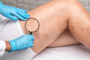 Doctor examining spider veins on woman’s legs with magnifying glass