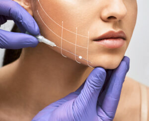 Woman during a PDO threadlift, revealing lifted skin