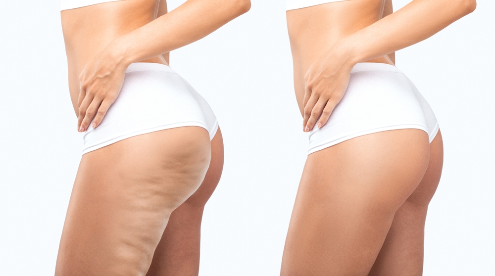 Woman wearing short white pants, before and after cellulite treatment