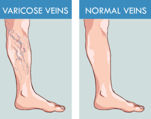 Illustration showing normal veins next to varicose veins
