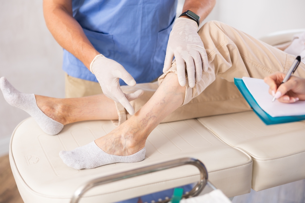 Professional phlebologists examining a female patient’s legs with visible varicose veins during a clinical evaluation, preparing for ambulatory phlebectomy to remove damaged veins and improve circulation.
