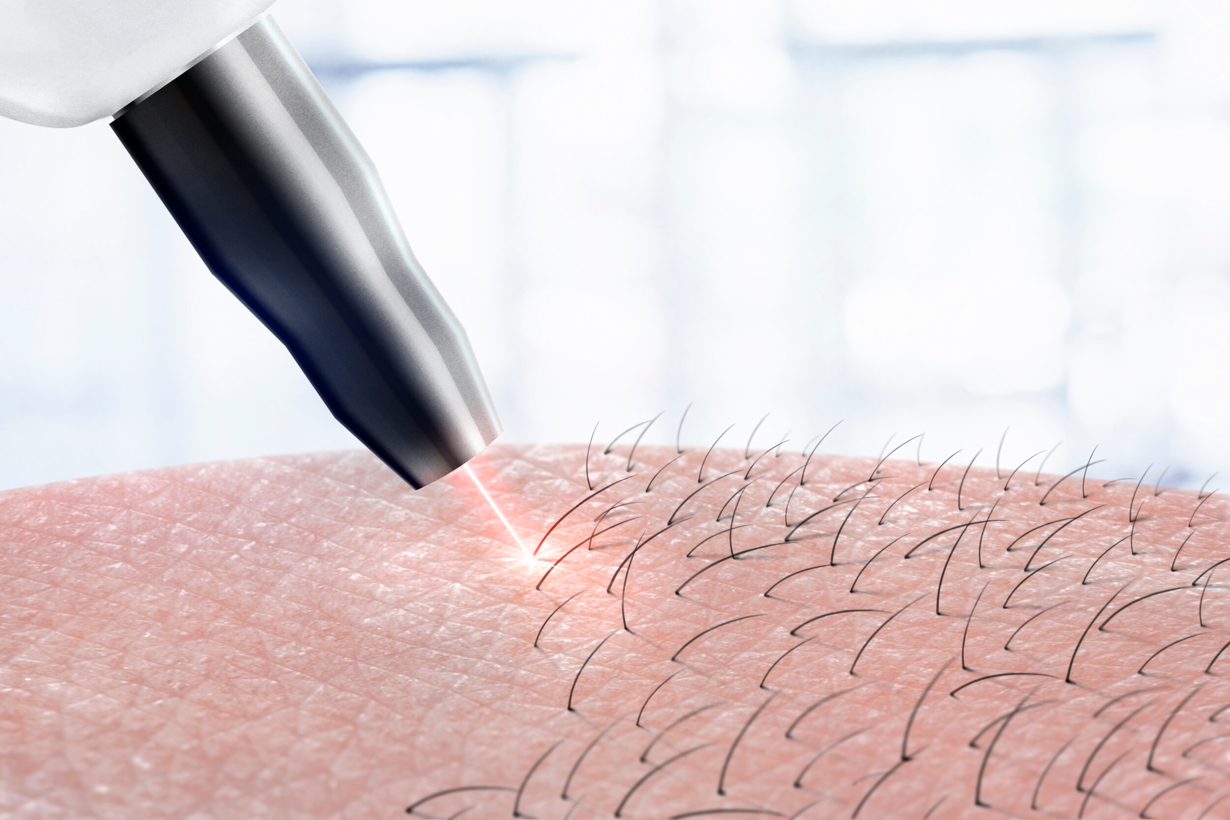 Hair Reduction Abingdon VA